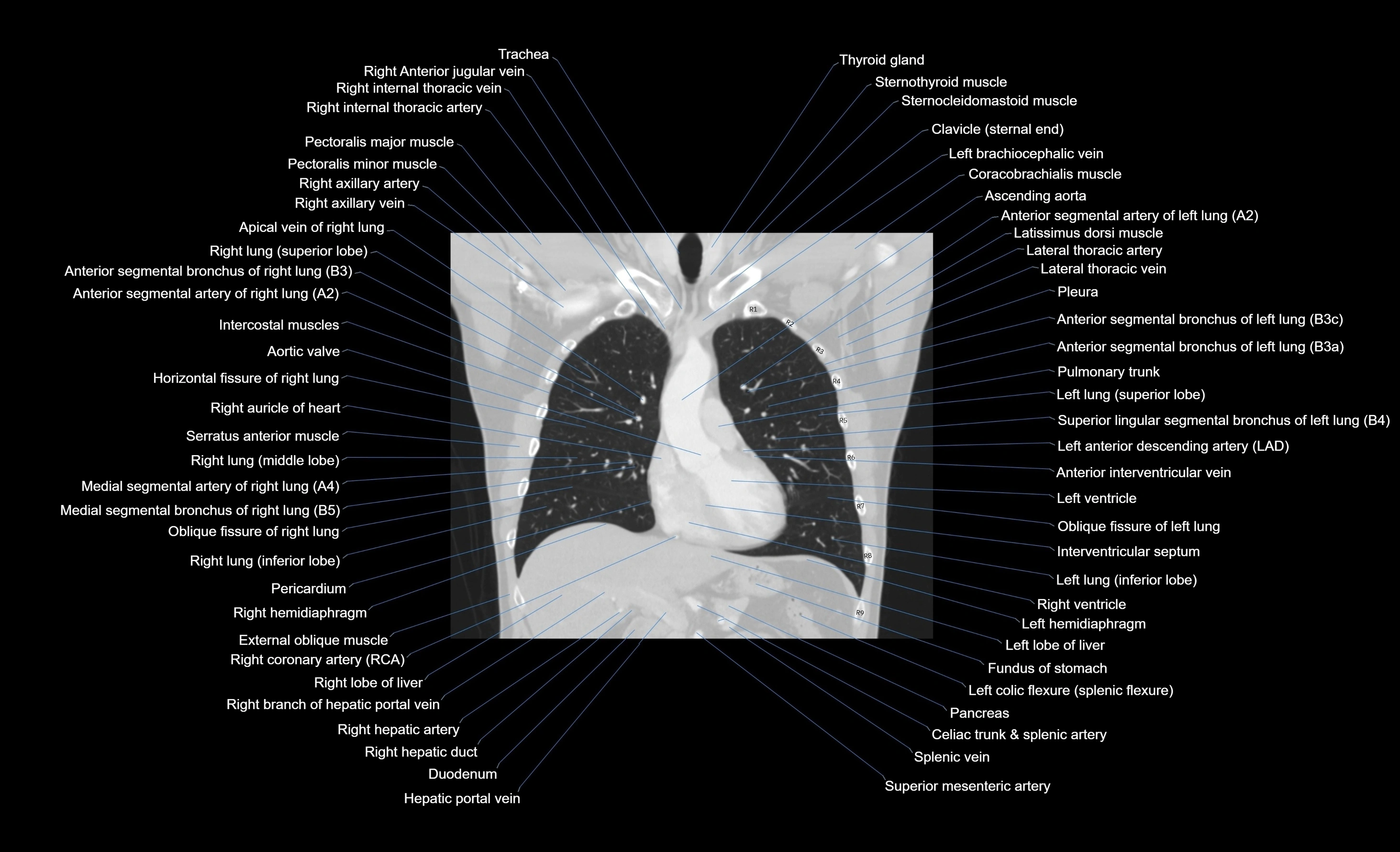 CT chest (thorax) labelled coronal cross sectional anatomy radiology image-00074.webp